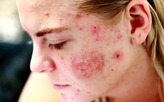 Rosacea (růžovka)