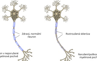 Roztroušená skleróza