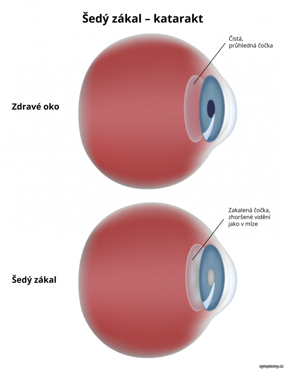 Šedý zákal - příznaky a léčba