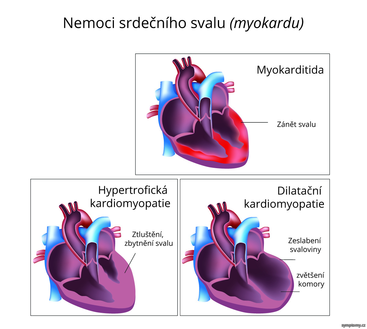Nemoci srdečního svalu (myokardu)