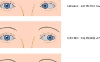 Strabismus