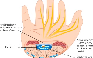 Syndrom karpálního tunelu