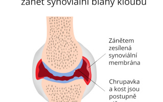 Synovitida