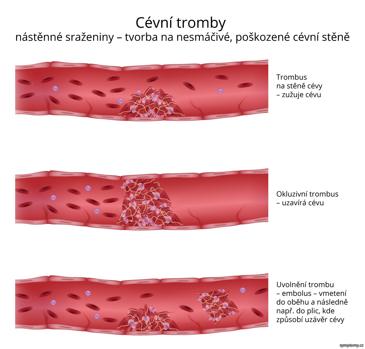 Cévní tromby