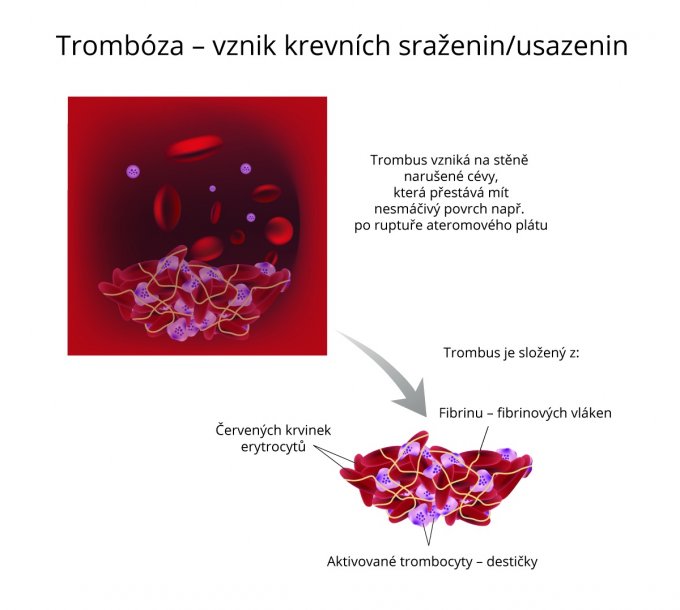 Vznik krevních sraženin a usazenin