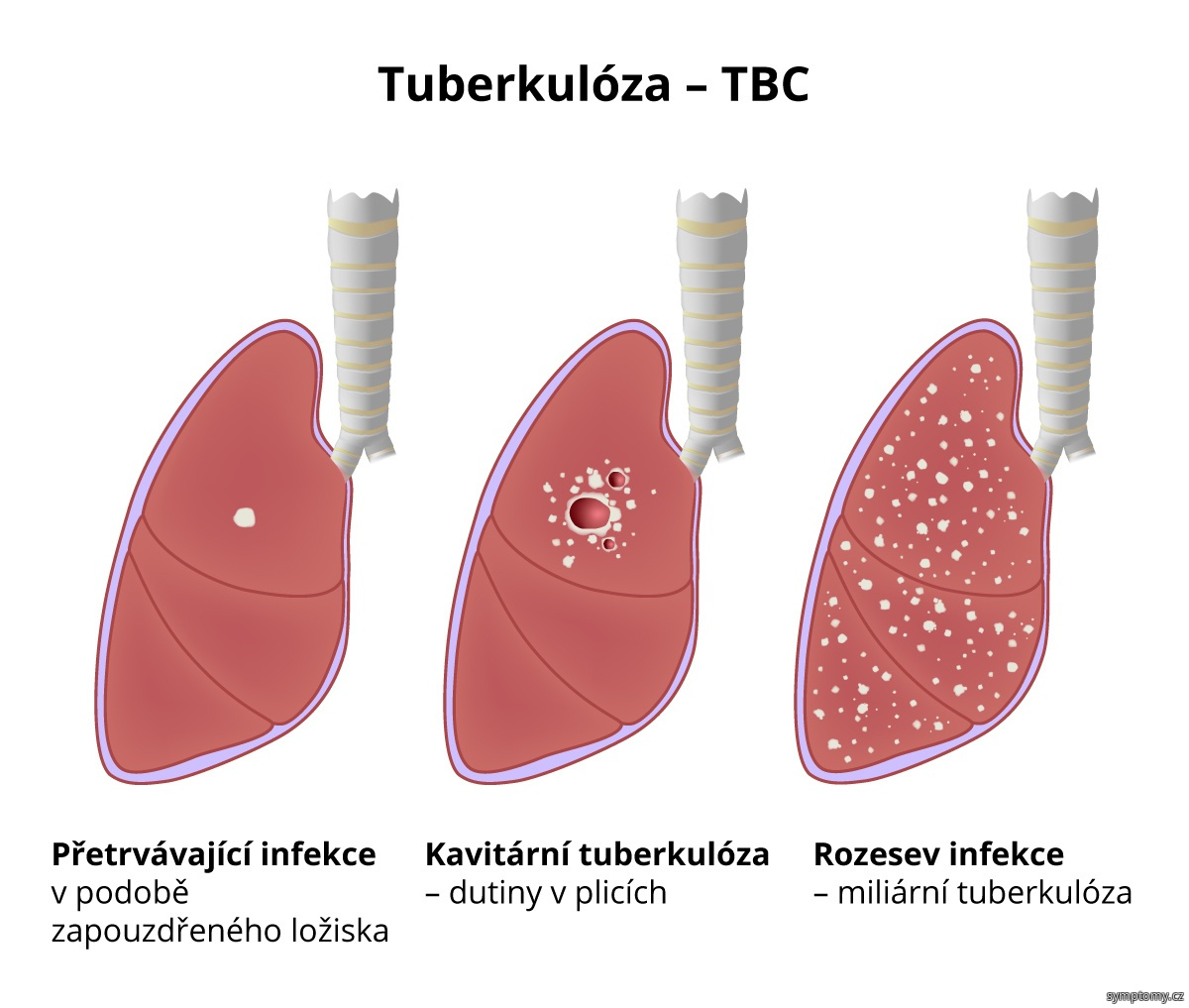 Tuberkulóza (TBC)