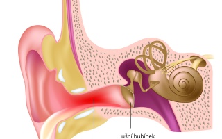 Ušní barotrauma