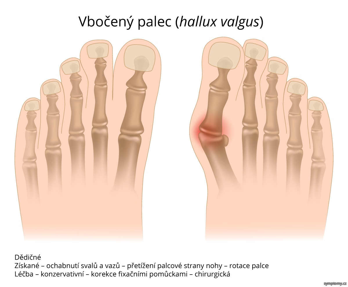 Jak se léčí Hallux?