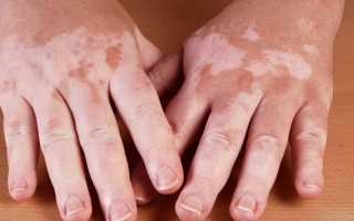 Vitiligo