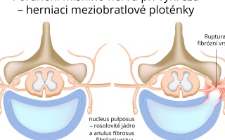 Výhřez meziobratlové ploténky