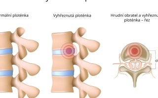 Výhřez meziobratlové ploténky