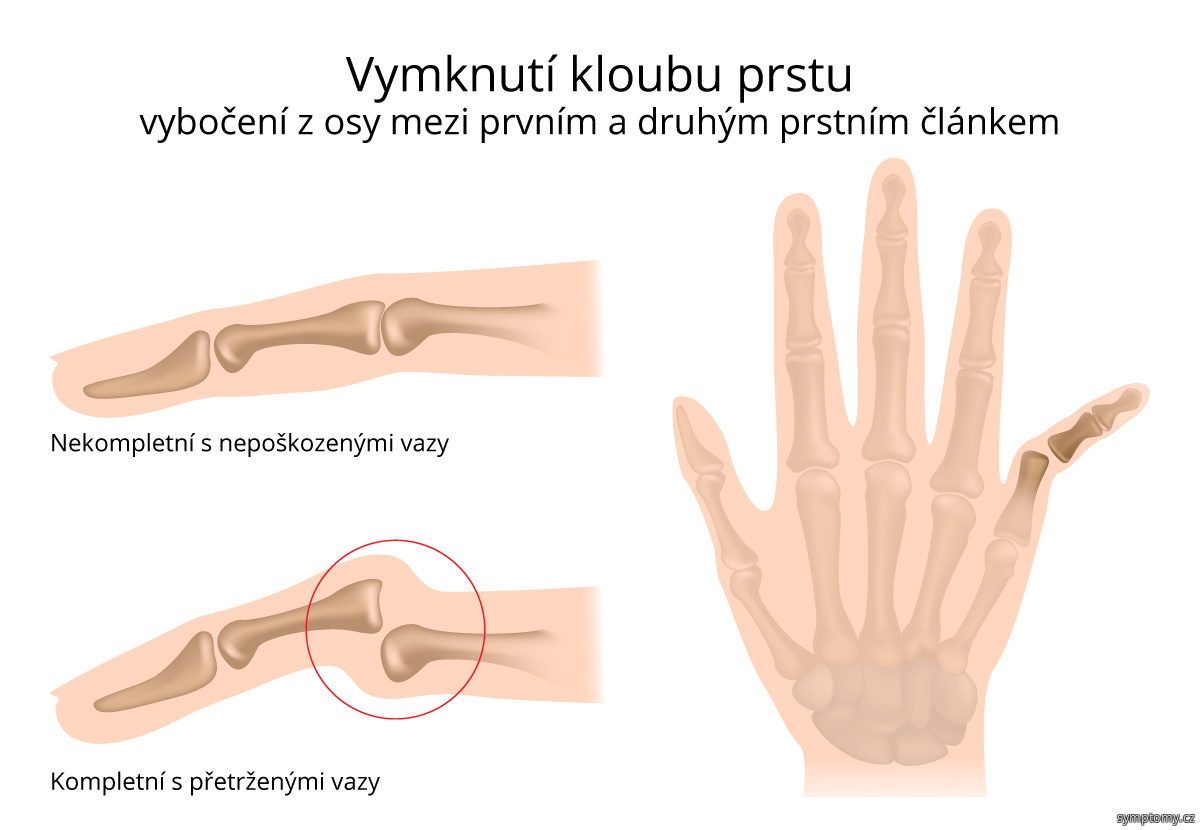 Jak dostat dehet z prstů?