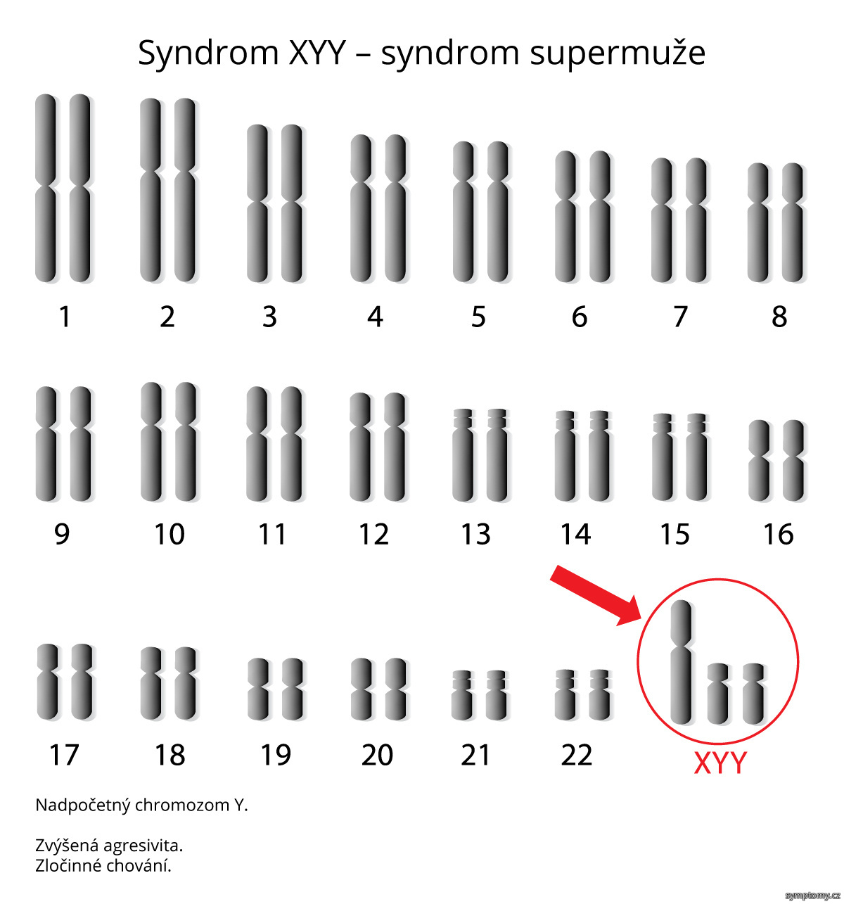 Syndrom XYY - syndrom supermuže