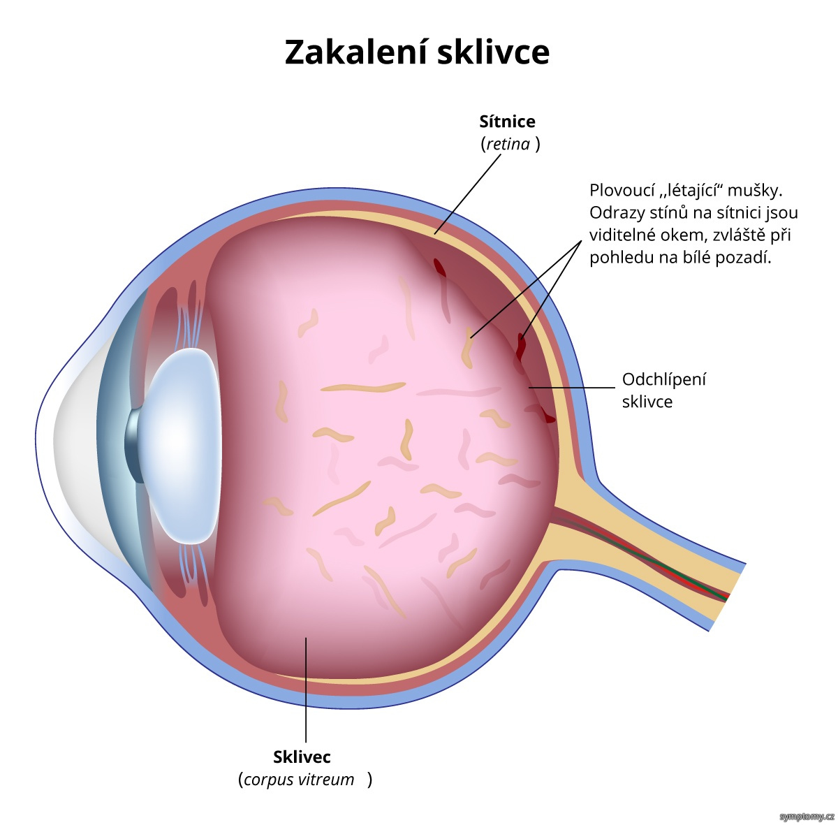 Jak vznikaji sklivcové zákalky?