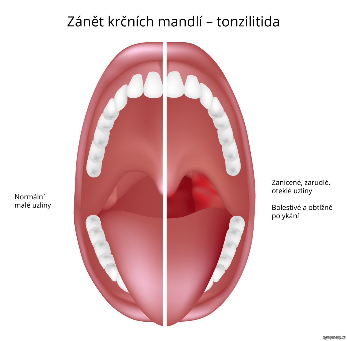 Co na zánět mandlí?