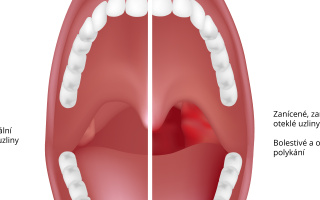 Zánět krčních mandlí – Tonzilitida