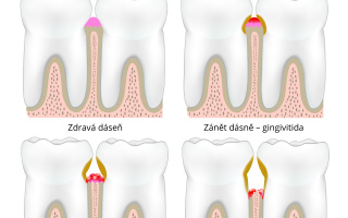 Zánět ozubice