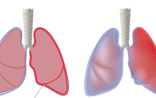 Zánět pohrudnice