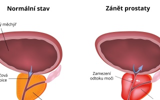 Zánět prostaty