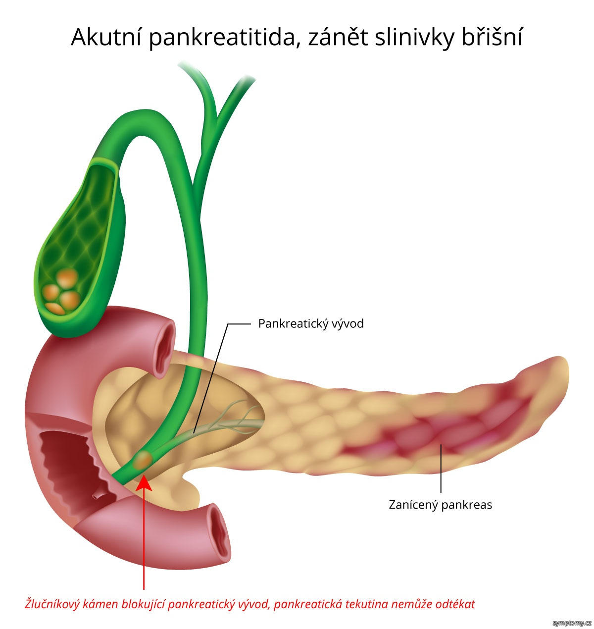 Akutní pankreatitida - zánět slinivky břišní