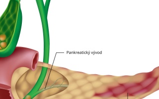 Zánět slinivky břišní