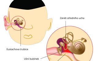 Zánět středního ucha