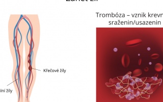 Zánět žil