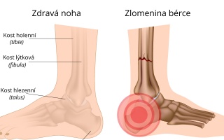 Zlomenina bérce včetně kotníku