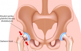 Zlomenina kyčelního kloubu