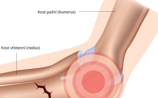 Zlomenina lokte a předloktí