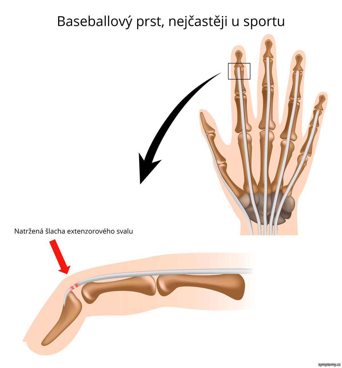 Jak poznat Zlomený malíček?