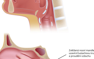 Zvětšené nosní mandle 