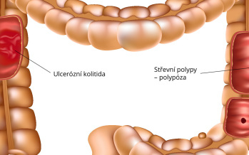 Choroby tlustého střeva