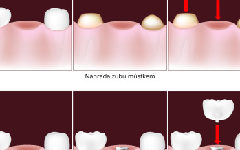 Dentální implantát nebo můstek?