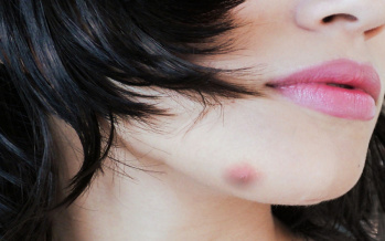 Absces