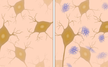 Alzheimerova choroba