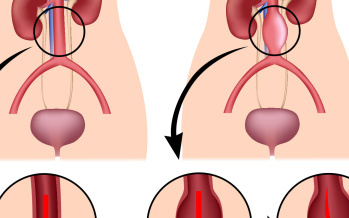 Aneurysma břišní aorty