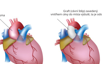 Aneurysma