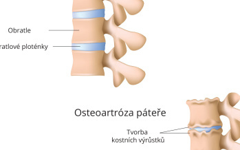 Artróza páteře