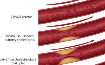 Ateroskleróza
