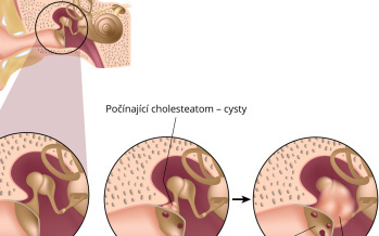 Cholesteatom