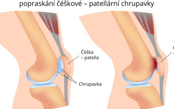 Chondromalácie čéšky