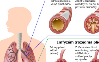 Chronická obstrukční plicní nemoc (CHOPN)