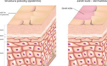 Dermatitida
