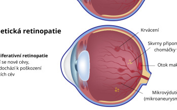 Diabetická retinopatie