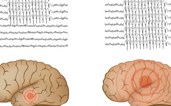 Epilepsie