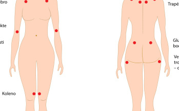 Fibromyalgie