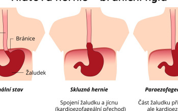 Hiátová hernie