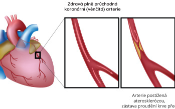 Ischemická choroba srdeční