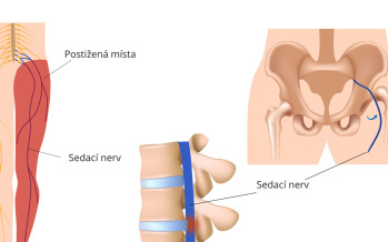 Ischias